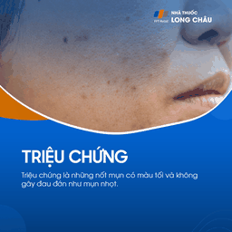 Mụn Đầu Đen 2