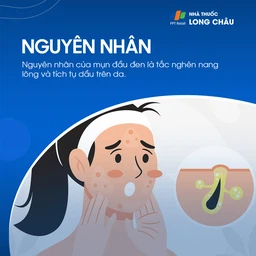 Mụn Đầu Đen 3