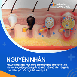 Mụn trứng cá 3