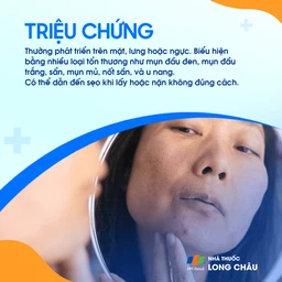 Triệu chứng mụn trứng cá trên da mặt của người trẻ