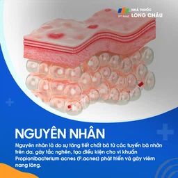 Nguyên nhân hình thành mụn do rối loạn nội tiết tố