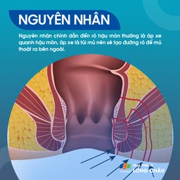 Rò hậu môn 3