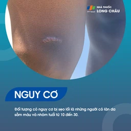 Sẹo Lồi 4