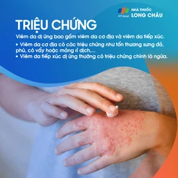 Viêm Da Dị Ứng 2
