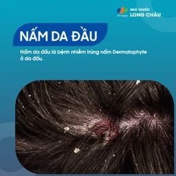 Nấm Da Đầu 1