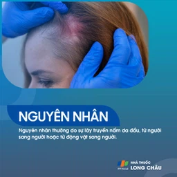 Nấm Da Đầu 3