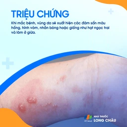 U mềm lây 2