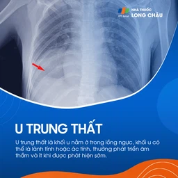 U trung thất 1