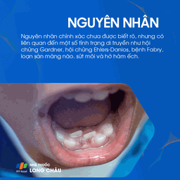 Răng thừa 3