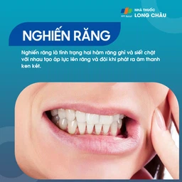 Nghiến răng 1