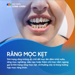 Răng mọc kẹt 1