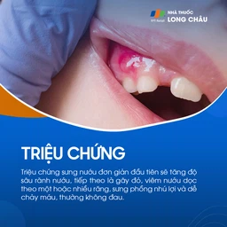 Sưng nướu 2