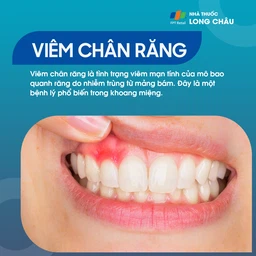 Viêm chân răng 1