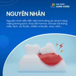 Viêm lợi 3