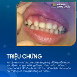 Viêm nha chu 2