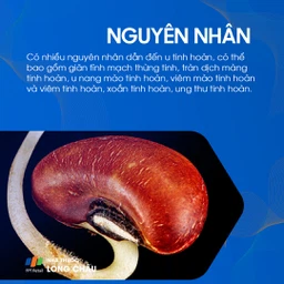U tinh hoàn 3