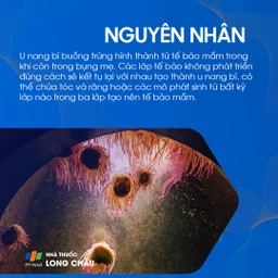 U bì buồng trứng 3