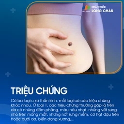 U xơ thần kinh 2