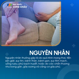 Phù chân 3