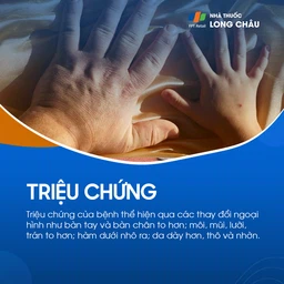 Bệnh to các viễn cực 2