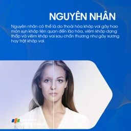 Viêm khớp vai 3