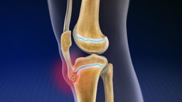 Cận cảnh đầu gối bị sưng do bệnh Osgood-Schlatter, một dạng viêm xương sụn gối phổ biến ở trẻ em đang phát triển