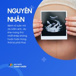 Rò luân nhĩ 3