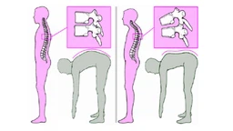 Bệnh Scheuermann là gì? Những điều cần biết về bệnh Scheuermann 2