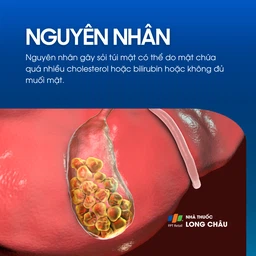 Sỏi túi mật 3