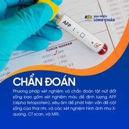 Tật nứt đốt sống 5