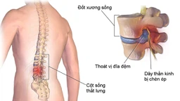 Thoát vị đĩa đệm là gì? Triệu chứng, nguyên nhân và cách điều trị 4