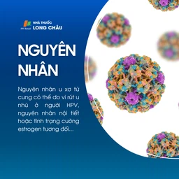 U xơ tử cung 3