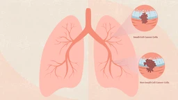 Ung thư phổi không tế bào nhỏ giai đoạn II: Hiểu rõ để điều trị tốt hơn 1