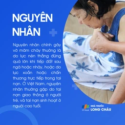 Vỡ mâm chày 3