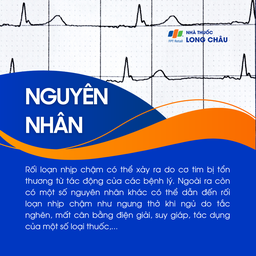 Rối loạn nhịp chậm 3