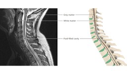 Rỗng tủy sống: Bệnh lý thần kinh hiếm gặp 1