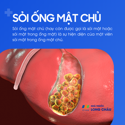 Sỏi ống mật chủ 1