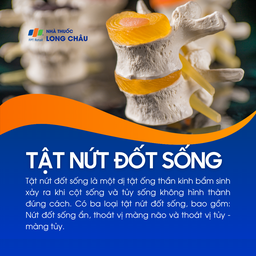 Tật nứt đốt sống 1