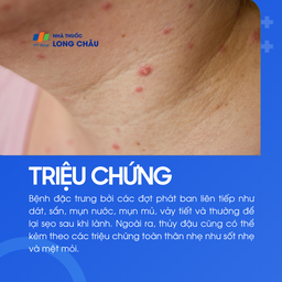 Các nốt phát ban và mụn nước điển hình của bệnh thủy đậu trên da bệnh nhân