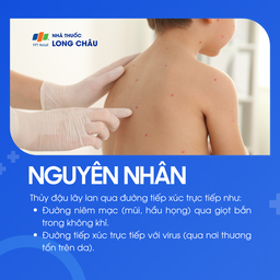 Nguyên nhân gây bệnh thủy đậu do virus Varicella-zoster lây qua đường hô hấp