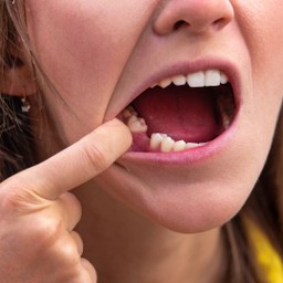 Tiêu xương hàm 2