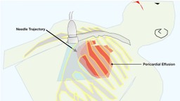  Tràn dịch màng tim: Triệu chứng, nguyên nhân, chẩn đoán và điều trị 3