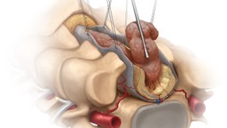 U tủy sống là gì? Nguyên nhân, triệu chứng và cách điều trị 1