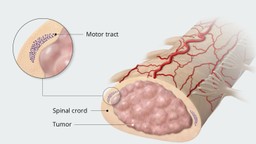 U tủy sống là gì? Nguyên nhân, triệu chứng và cách điều trị 3