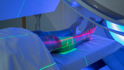 Ung thư mô liên kết 3