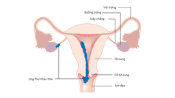 Ung thư nhau thai: Nguyên nhân, triệu chứng, chẩn đoán và điều trị 1