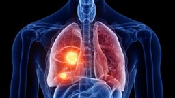 Ung thư phổi không tế bào nhỏ giai đoạn III cần chú ý những gì? 1