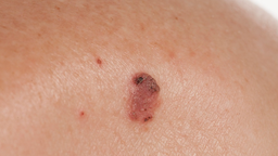 Ung thư tế bào vảy là gì? Triệu chứng, nguyên nhân, chẩn đoán và điều trị bệnh 2