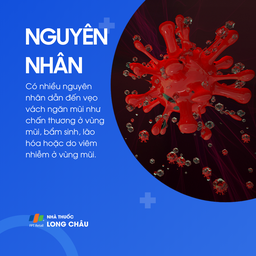 Vẹo vách ngăn mũi 3