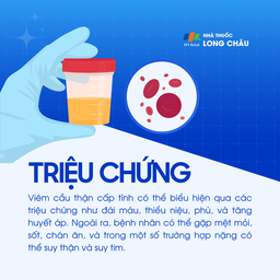 Viêm cầu thận cấp 2
